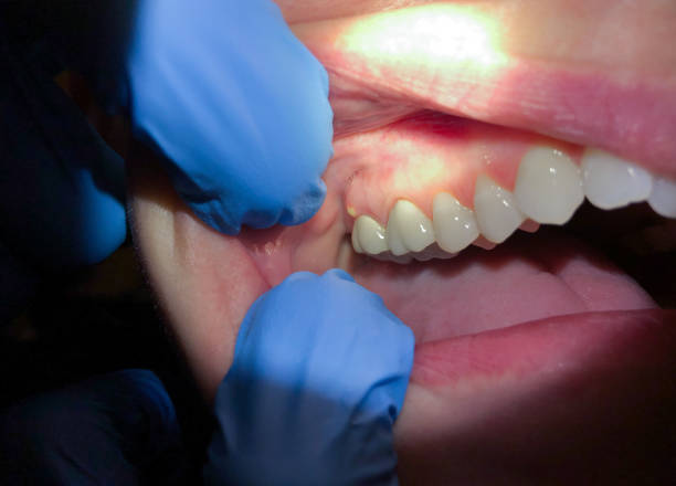 Best Root Canal Emergency Dentist  in Cypress Quarters, FL